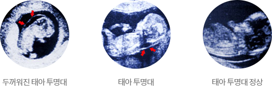 두꺼워진 태아 투명대, 태아 투명대, 태아 투명대 정상