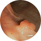 대장용종 이미지 1