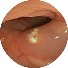 대장용종 이미지 2