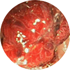 거대대장용종 이미지 1