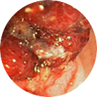 거대대장용종 이미지 2