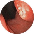 조기위암 이미지 1