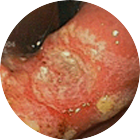 조기위암 이미지 3