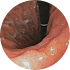 조기위암 이미지 4