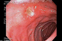 십이지장궤양 이미지 1