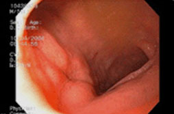 십이지장궤양 이미지 2