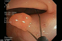 내시경적용종제거술 이미지 1