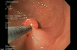 내시경적용종제거술 이미지 2